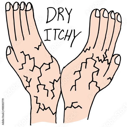 Hands that are dry and itchy