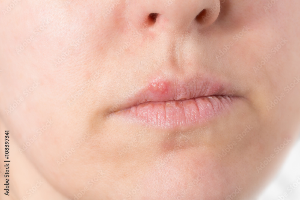 Lippenherpes Lippenherpes