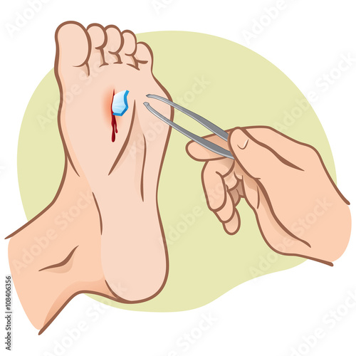 Person injured foot with broken glass, pulling with forceps, caucasian