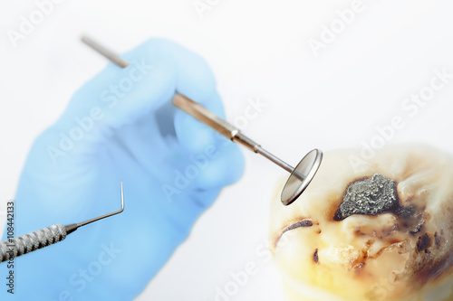 Dentist's tools in dentist hands with blue gloves and big wisdom photo