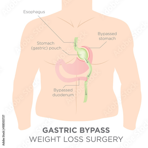 Gastric Bypass for Weight Loss - You Are Actually Re-routing Your Stomach in Order to Feel Full and Eat Less