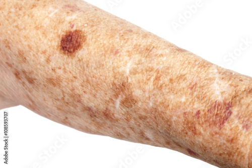 Female senior citizen arm with age spots (also known as liver spots, Solar lentigo, Lentigo senilis and Senile freckle) shot on a white background.  photo