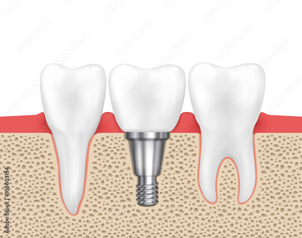 Dental human implant Dental human implant
