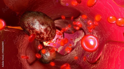 Bilde på lerret Tumour cells in blood vessels