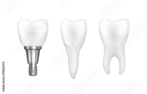 Tooth implants and normal tooth isolated on white background