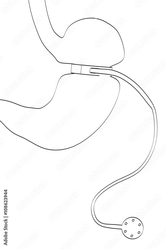 2d cartoon illustration of stomach with gastric band