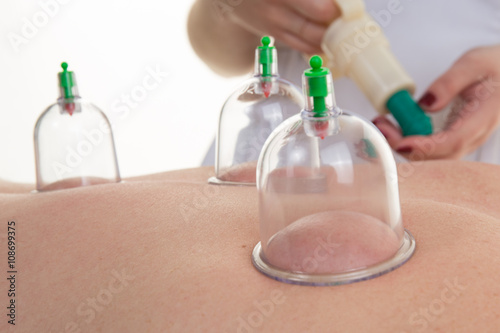 Acupuncture Therapist Placing Cup On The Back Of A Female Patient photo