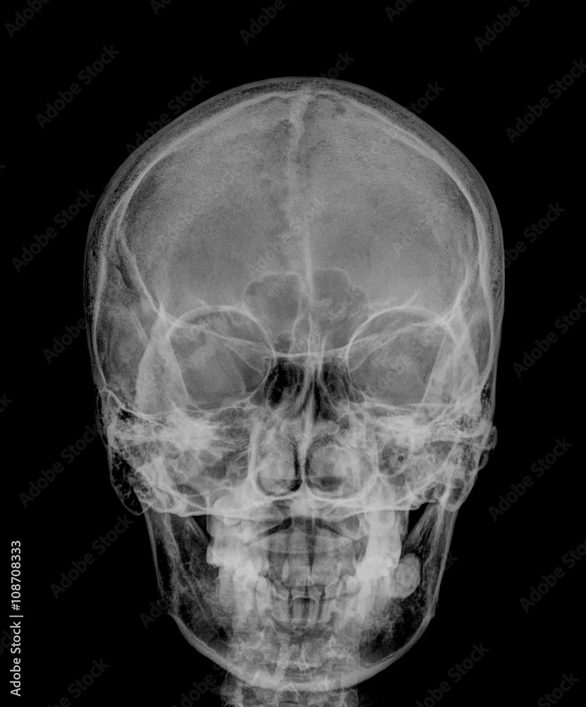 skull x-rays image sagital plane skull x-rays image sagital plane