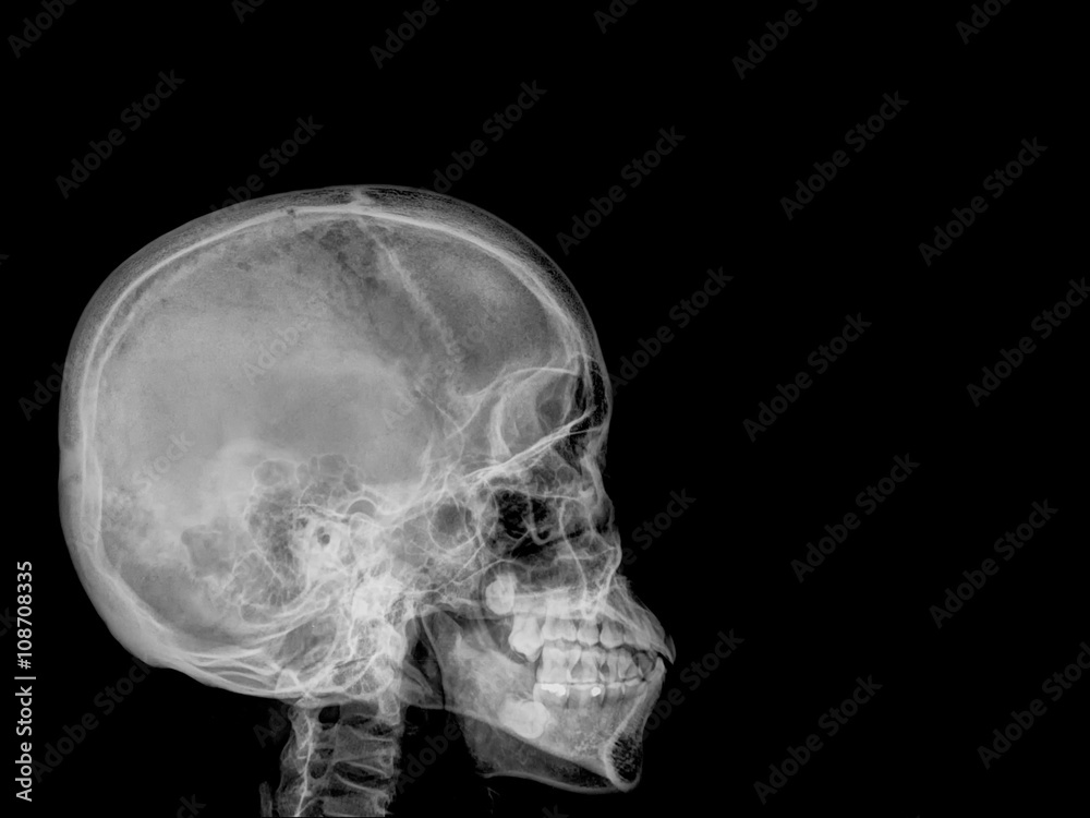 skull x-rays image sagital plane skull x-rays image sagital plane