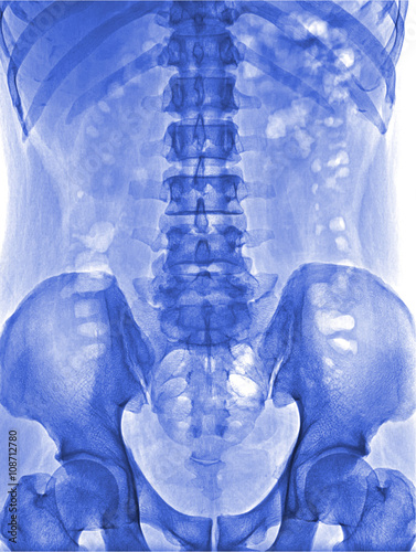 X-ray lumbo-sacral spine and pelvis