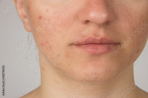Herpes with pus on the lips of a young girl and pimples on the f