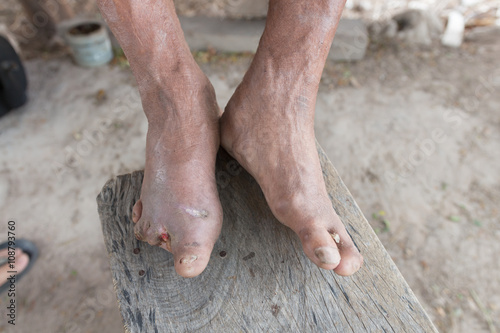 Hansen's disease,closeup hands of old man suffering from leprosy