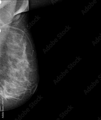 X-ray of Breast Cancer