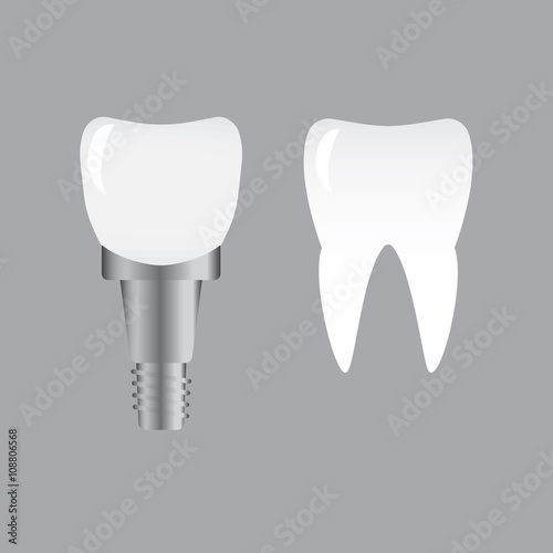 Tooth implants and normal tooth isolated on white background. Screw implant, dental inplant tooth, bone implantation