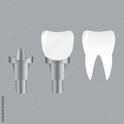Tooth implants and normal tooth isolated on white background. Screw implant, dental inplant tooth