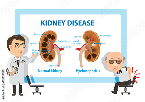 Pyelonephritis/Patients and doctors Viewing diagrams Pyelonephritis. Vector illustration.