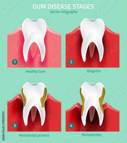 Teeth infographic vector