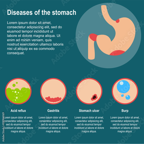 Diseases of the stomach. Vector illustration
Damage to the stomach. Poster about common diseases of the stomach.