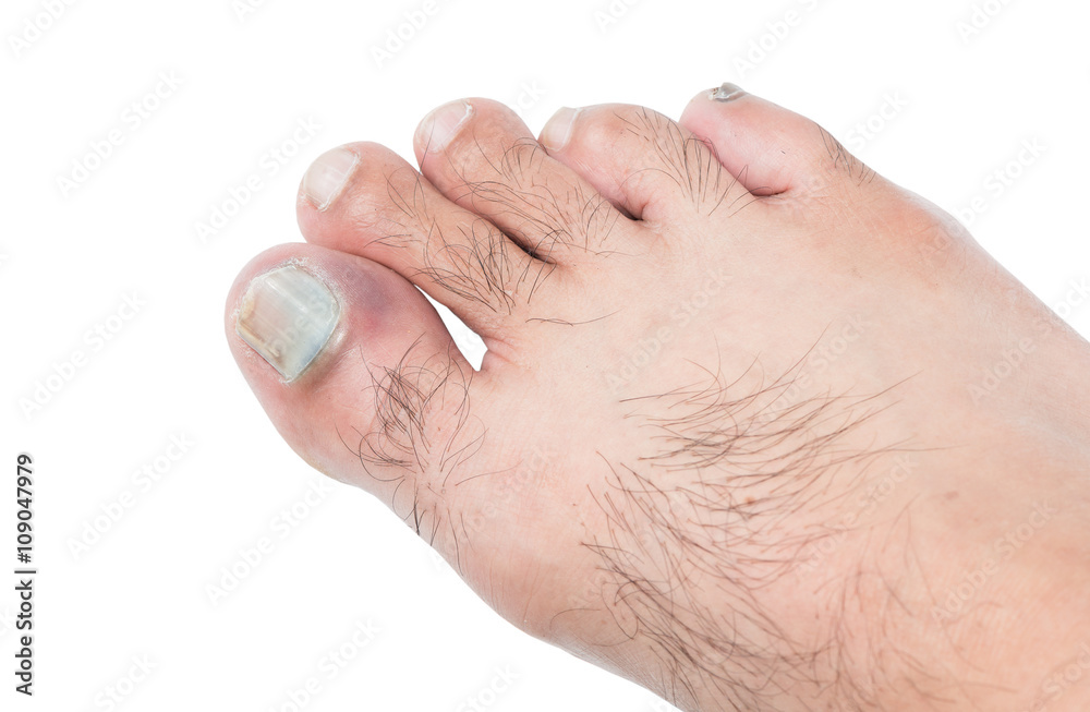 Fototapeta premium bruised on toenail