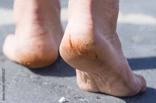 Macro photo of cracked heels. Male back view. 