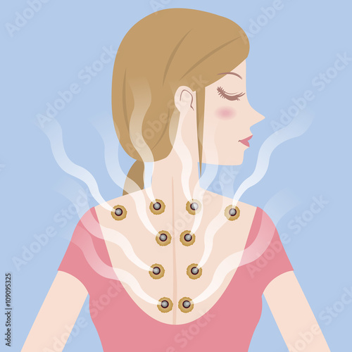 Canvas-taulu young woman and moxibustion, moxa cautery, vector illustration