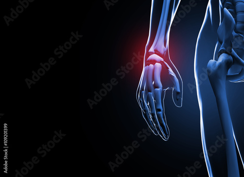 Fototapeta Naklejka Na Ścianę i Meble -  3d render Human hand and wrist pain caused by arthritis and carpal tunnel syndrome injury in the hand joint as an anatomy with skeleton and highlighted injured body part as a medical and health care.