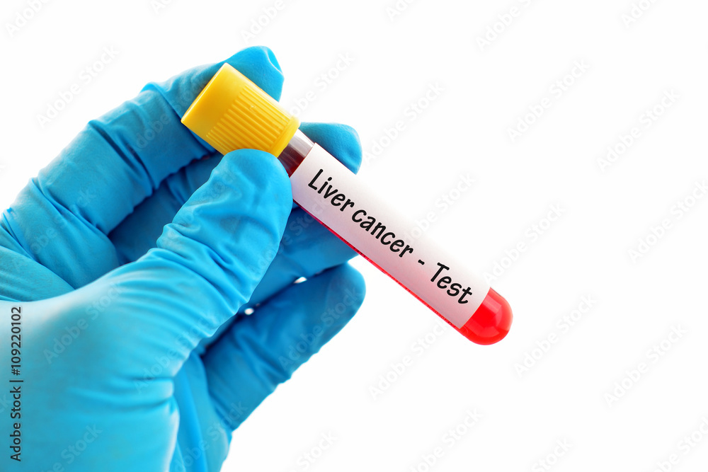 Obraz premium Liver cancer test 
