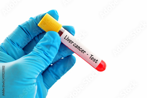 Liver cancer test
 photo