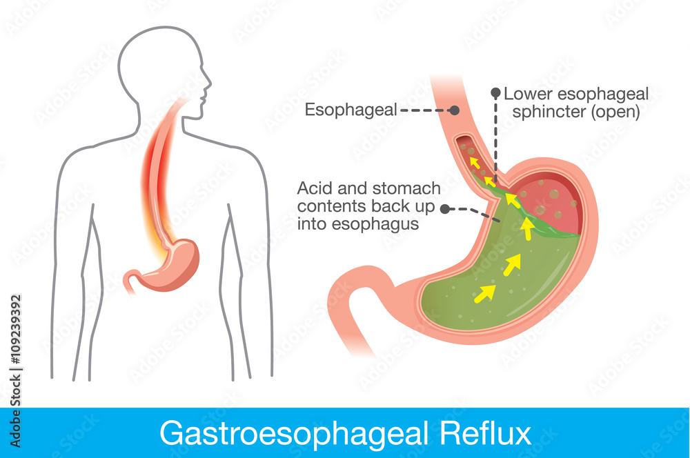 Picture of human stomach in problem area have acid back up into