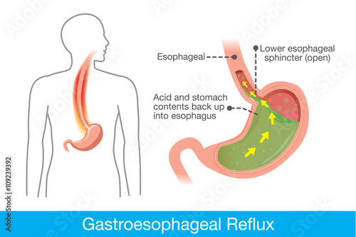 Picture of human stomach in problem area have acid back up into esophagus which is cause gastroesophageal reflux disease.