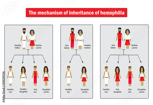 The mechanism of inheritance of hemophilia. Infographics. Vector illustration on isolated background