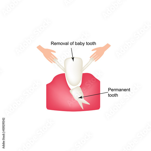 Removing baby teeth. Infographics. Vector illustration on isolated background