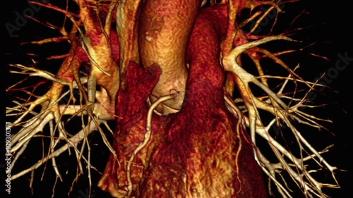 Right coronary artery photo