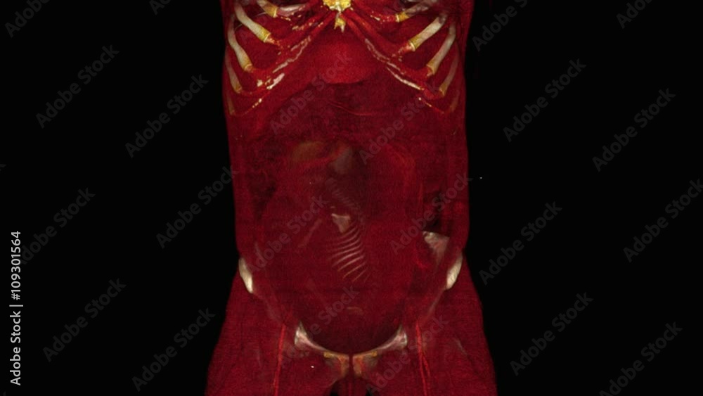 Full term pregnancy with fetus in breech position
