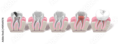 Tablou pe pânză 3d renderings of endodontics - root canal procedure