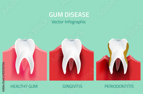 Gum disease stages. Teeth infographic photo