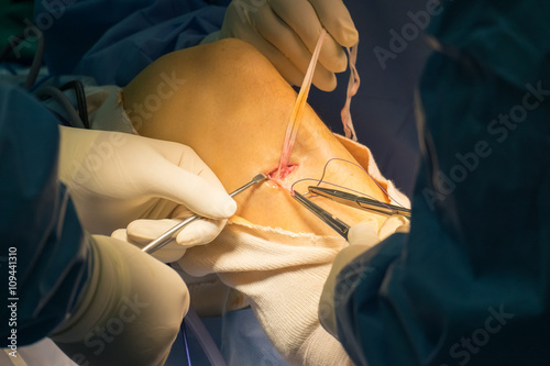 Preparation tendon For ACLR (Arthroscopic ACL reconstruction) photo