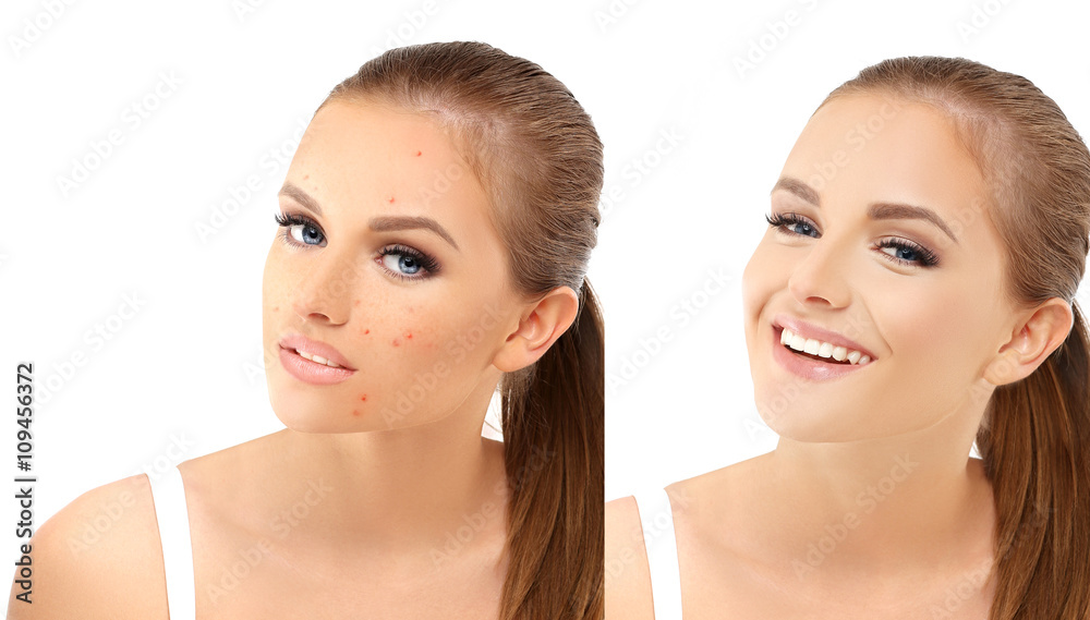 Portrait of beautiful girl with problem and clear skin Portrait of beautiful girl with problem and clear skin