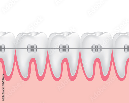 teeth braces illustration.