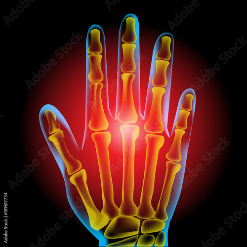 Hand pain