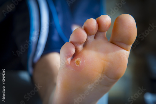 Calluses on foot