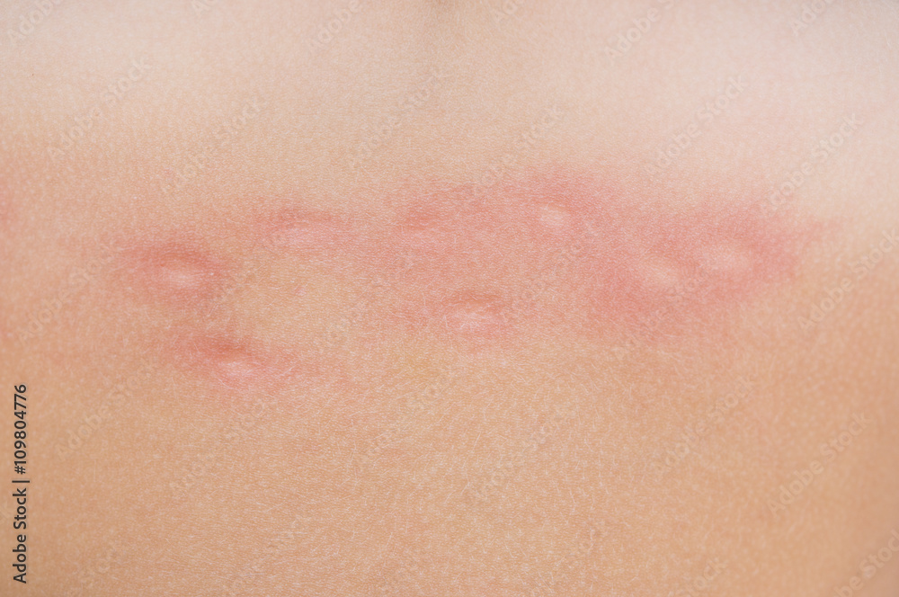 mosquito bites on skin