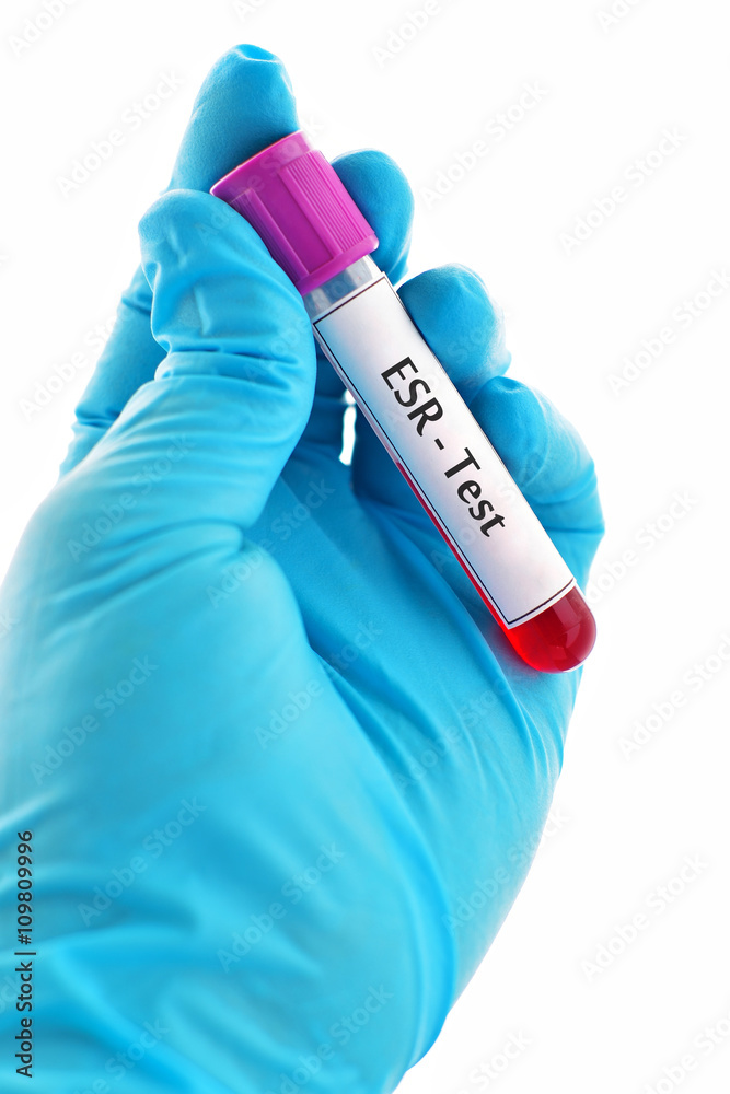 Blood sample for erythrocyte sedimentation rate (ESR) test Stock Photo