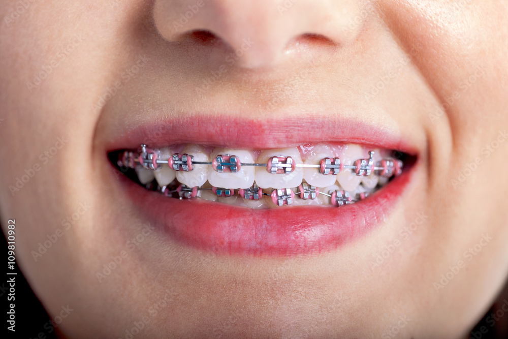 Perfect White Teeth With Braces