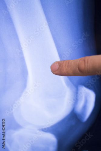 Knee injury surgical implant xray scan