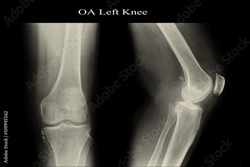 OA Left Knee