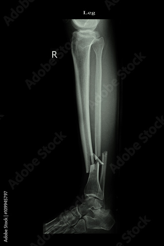 fracture left leg tibia and fibula