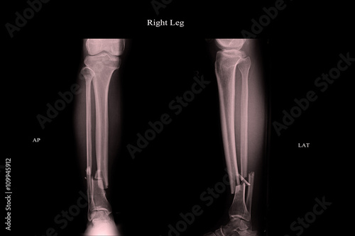 closed fracture left leg tibia and fibula