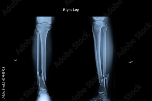 closed fracture left leg tibia and fibula