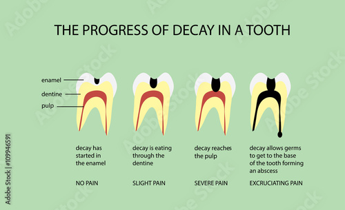 The Progress of Decay in a Tooth Diagram
